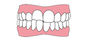交叉咬合（クロスバイト）