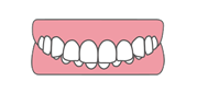 過蓋咬合（ディープバイト）